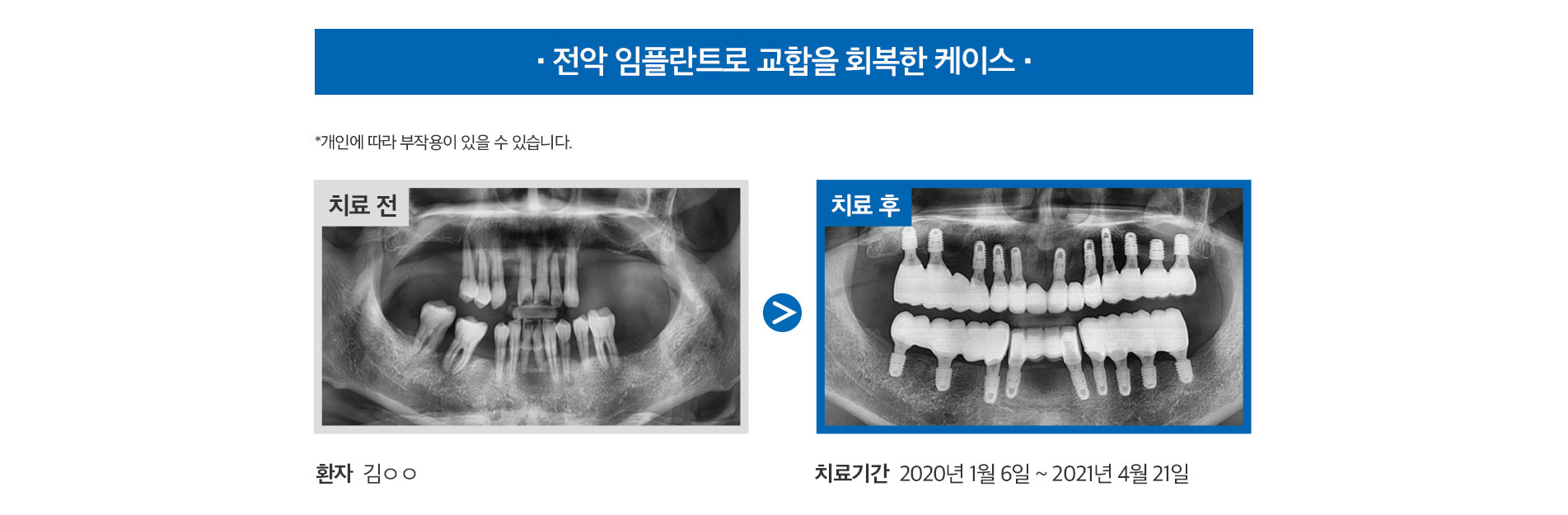 전악 임플란트로 교합을 회복한 케이스