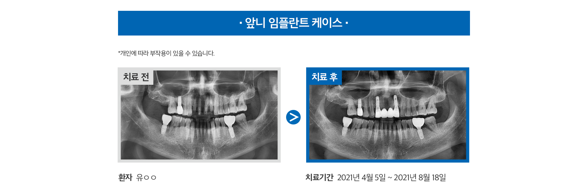 앞니 임플란트 케이스