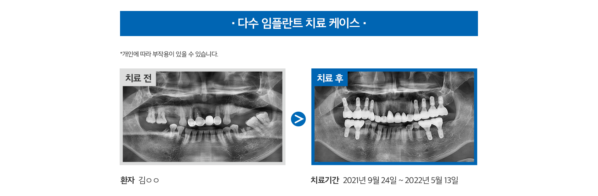 다수 임플란트 치료 케이스