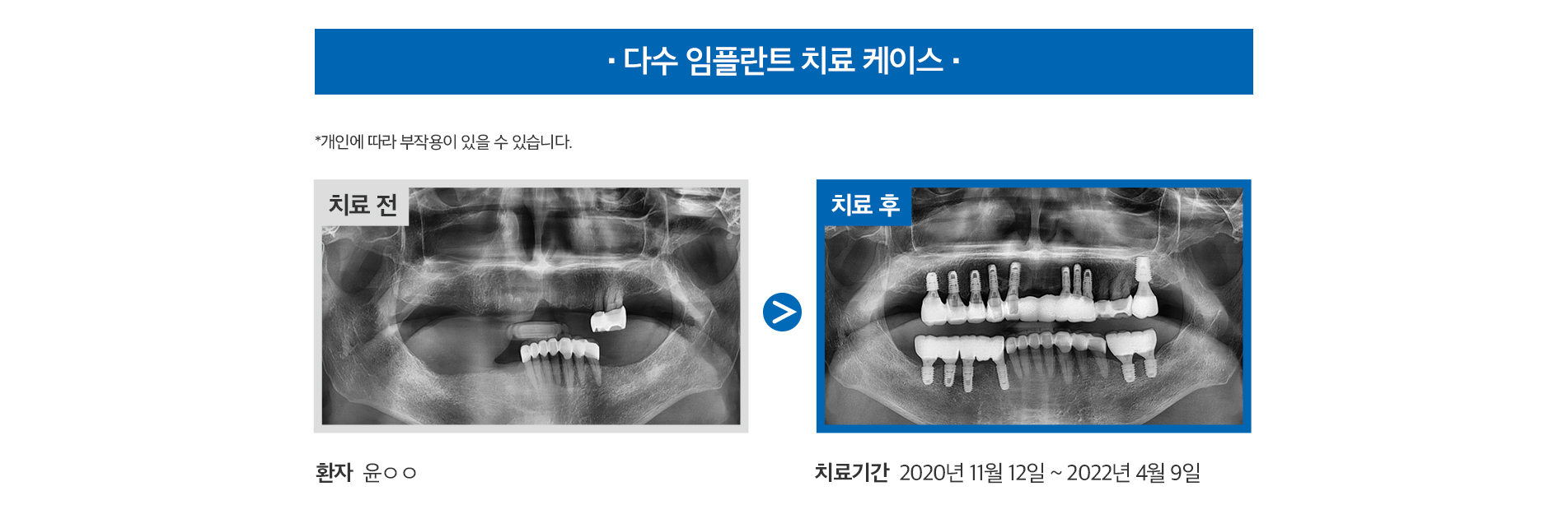 앞니 임플란트 케이스